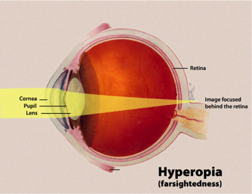 What Is Nearsightedness And Farsightedness